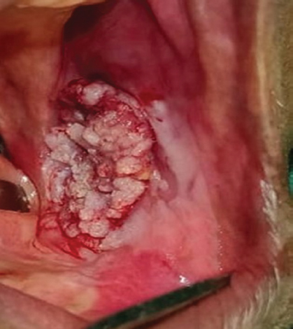 Clinical image showing single, exophytic cauliflower-like whitish-pink-coloured, well-defined growth on the left buccal mucosa approximately measuring 3 × 3 cm in size extending to the buccal vestibule.